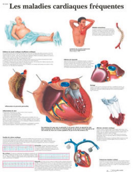 maladies-cardiaques